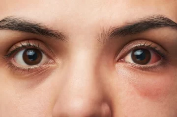 La conjuntivitis puede ser un síntoma de Covid-19