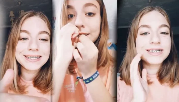 Los brackets falsos, la peligrosa moda de TikTok que siguen los jóvenes