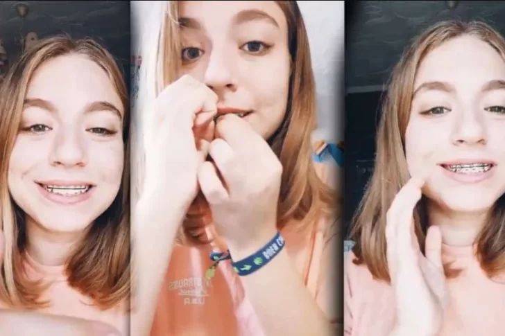 Los brackets falsos, la peligrosa moda de TikTok que siguen los jóvenes