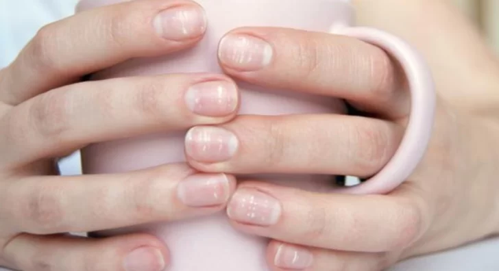 Por qué aparecen puntitos blancos o rayas en las uñas