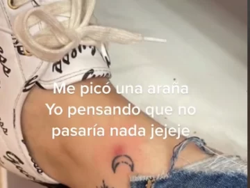 La picó una araña sobre un tatuaje y mostró cómo quedó su pierna luego de dos meses