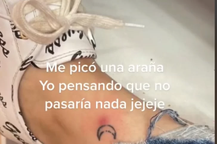 La picó una araña sobre un tatuaje y mostró cómo quedó su pierna luego de dos meses