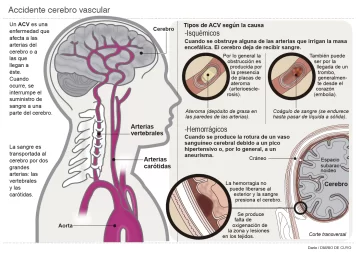 En los últimos 4 meses se atendió una cantidad inusual de jóvenes con ACV