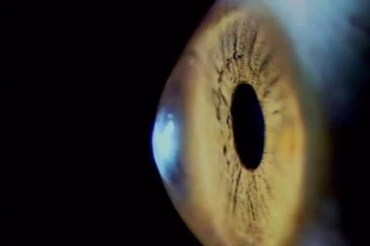 “Ojo Covid”: un nene de 9 años casi pierde la visión tras contagiarse coronavirus