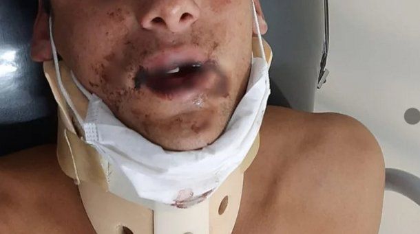 Pelea entre rugbiers: evoluciona el joven golpeado e identifican a los agresores