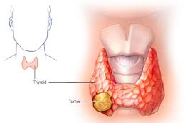 Los síntomas que alertan sobre el cáncer de tiroides