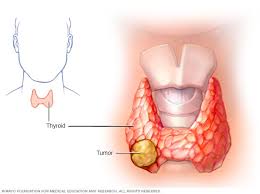 Los síntomas que alertan sobre el cáncer de tiroides