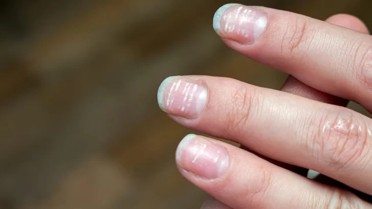 Estrías en las uñas: ¿Qué significan y cómo prevenirlas?