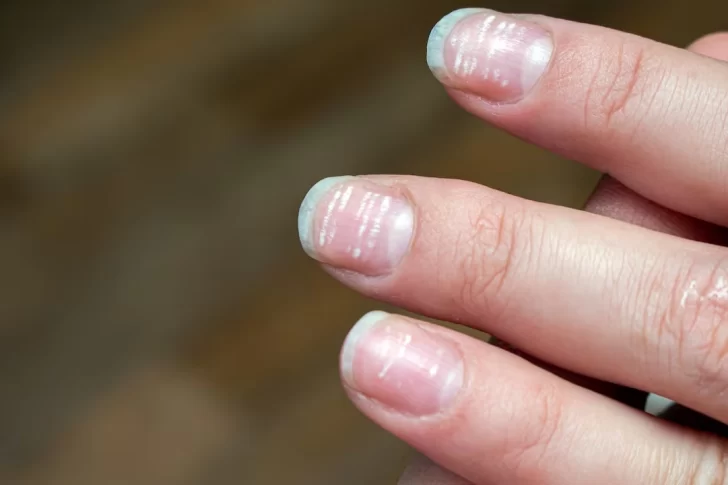 Estrías en las uñas: ¿Qué significan y cómo prevenirlas?