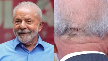 Lula da Silva fue operado de emergencia por una hemorragia intracraneal tras una caída